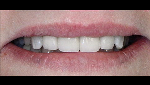After image