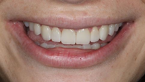 After image