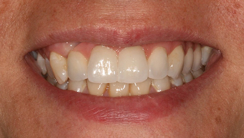 After image
