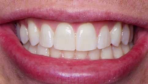 After image