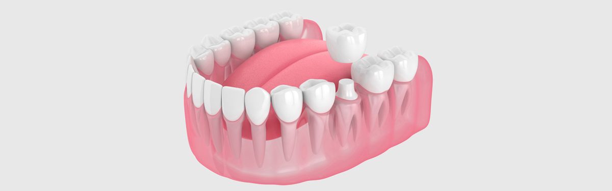 Is crown lengthening worth it