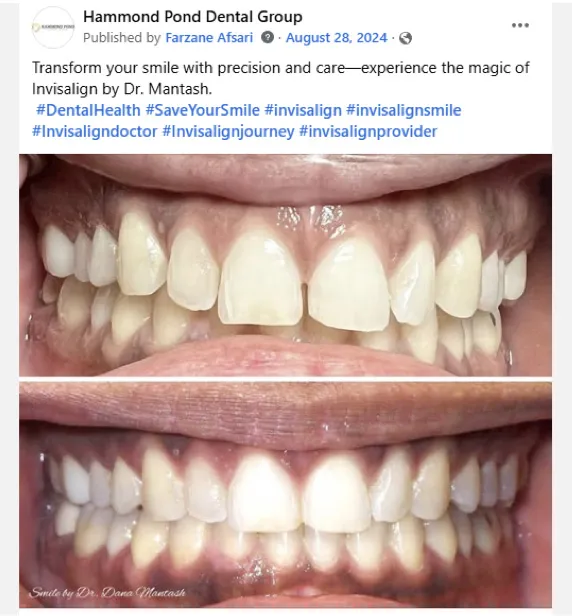 Before-and-after photos showing a patient’s teeth prior to Invisalign treatment and improved alignment after treatment.